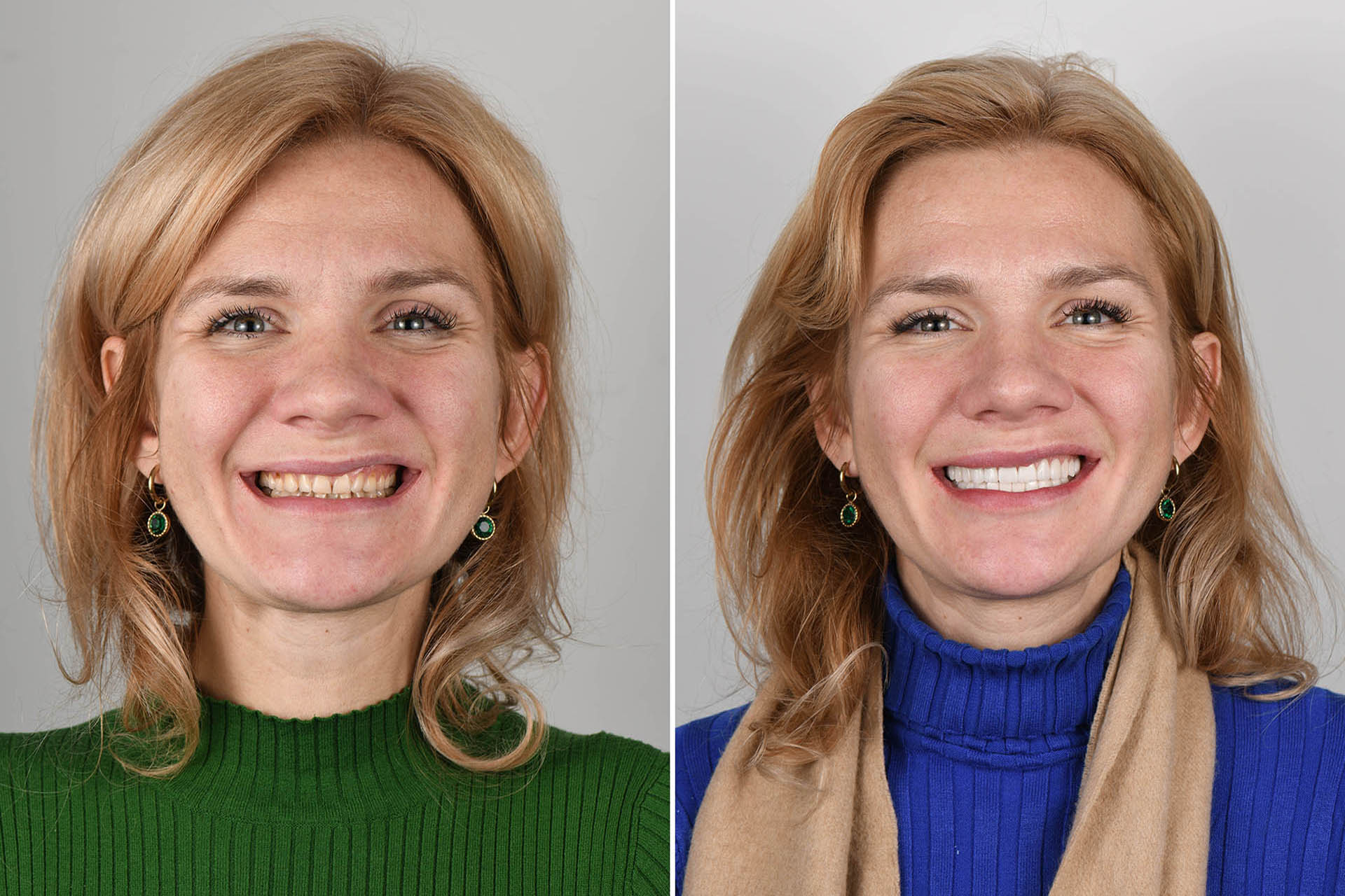 New,Created,Dental,Smile,By,Ceramic,Veneers