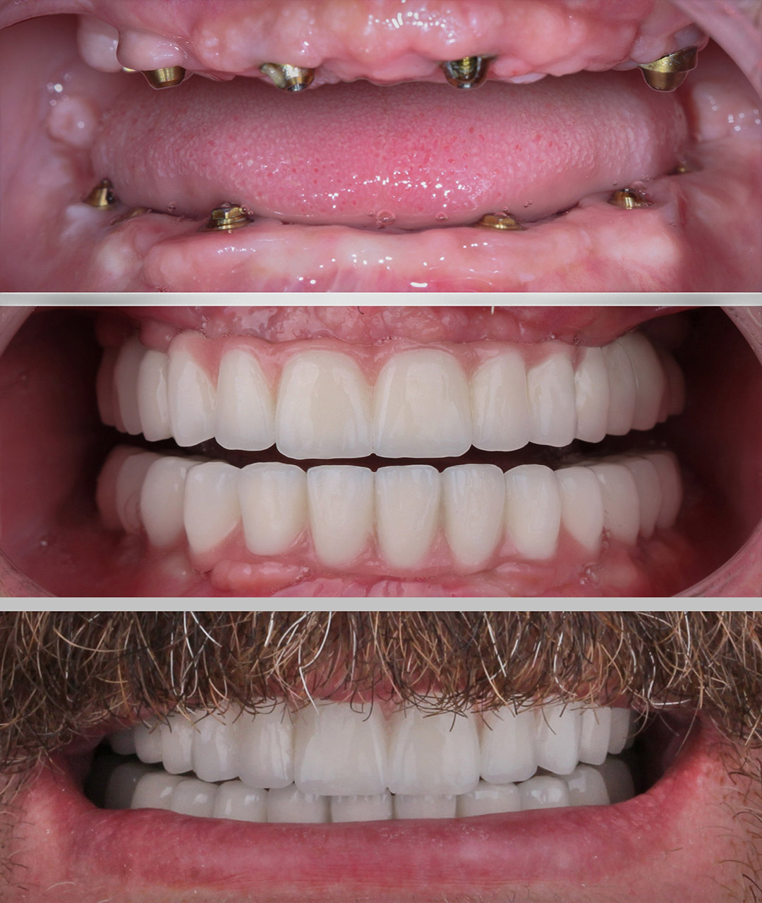 all-on-x, all-on-6 full jaw implants