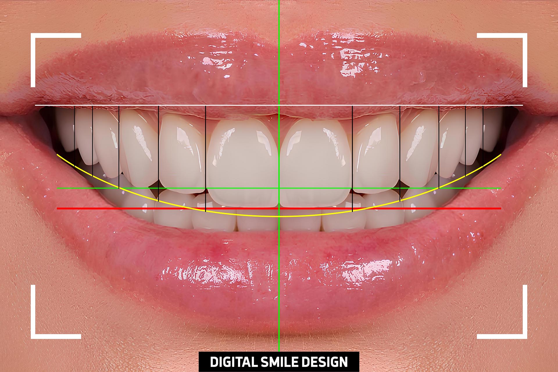 CAD Smile Design