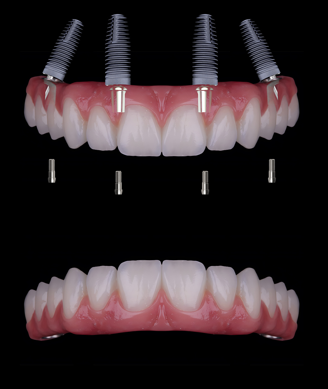 Implant supported zirconia bridge
